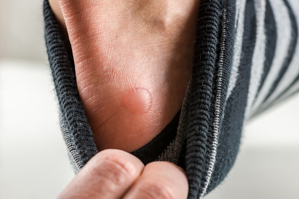7 Ways a Foot Doctor Can Treat Painful Blisters