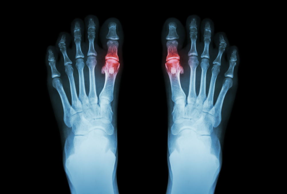 Ask a Foot Specialist: Will I Need Surgery for a Metatarsal Injury?