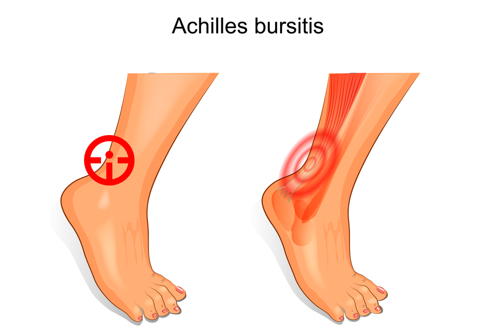 How Long Does It Take for Achilles Bursitis to Heal?